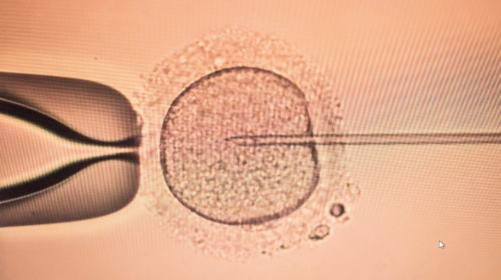 Knstliche Befruchtung (IVF) im Ausland | Qunomedical