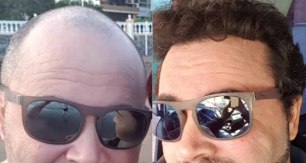 Man showing his hair before and after undergoing a hair transplant surgery.