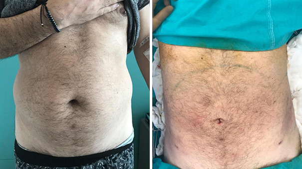Man showing his stomach before and after undergoing liposuction for men.