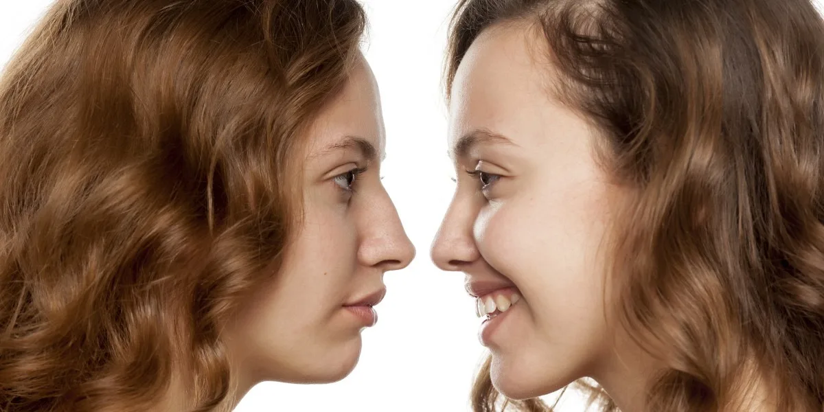 Junge Frau vor und nach einer Nasenkorrektur
