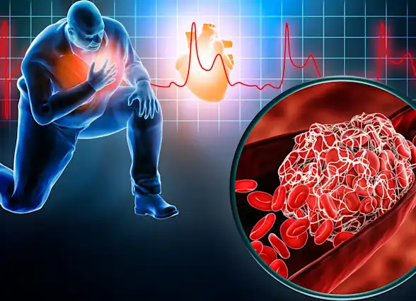 Myocardial Infarction Definition