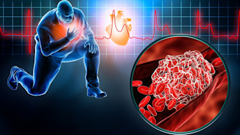 Definición de infarto de miocardio (ataque al corazón)