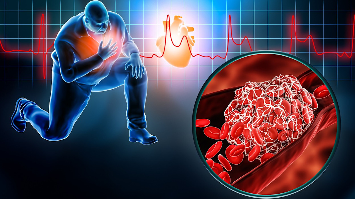 Helpful App — Definition of Myocardial Infarction (Heart Attack)