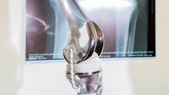 ¿Qué es la artroplastia (sustitución) de rodilla?