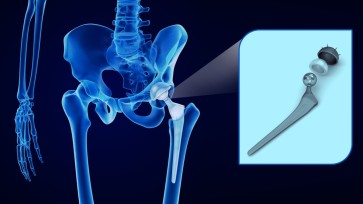 ¿Qué debo saber sobre la artroplastia (sustitución) de cadera?