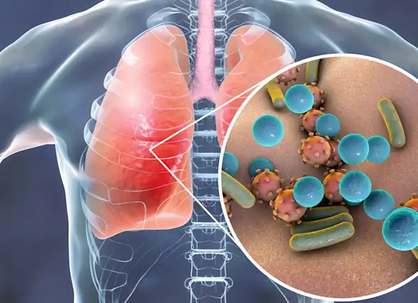 Pneumonia
