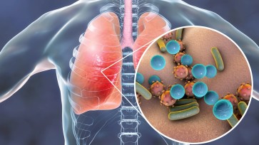 Pneumonia Definition and Causes