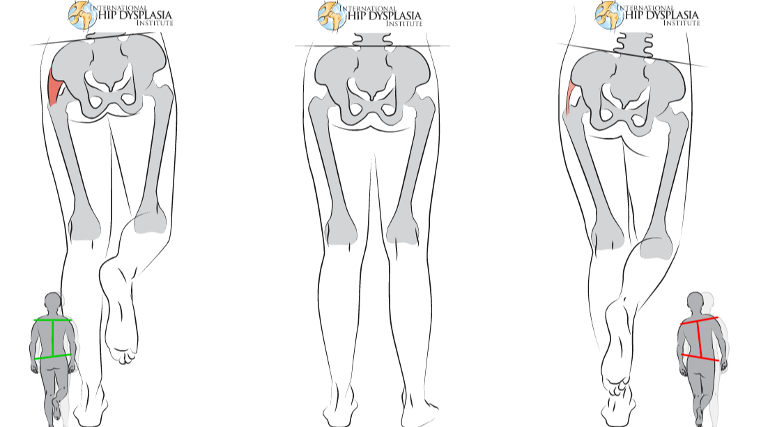 Helpful App — PreOp Prep for Hip Arthroplasty (Replacement)
