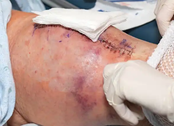 Knee Replacement Risks