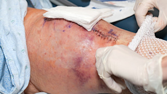 Artroplastia de rodilla (sustitución) Beneficios, riesgos y complicaciones