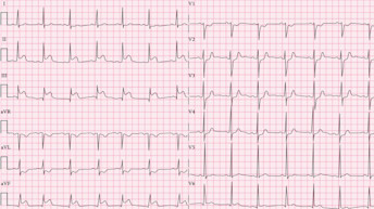 Diagnóstico y tratamiento del infarto de miocardio
