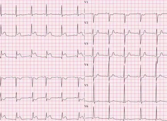 Heart Attack: Diagnosis & Treatment