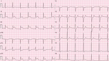 Diagnóstico y tratamiento del infarto de miocardio