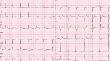 Heart Attack Diagnosis and Treatment