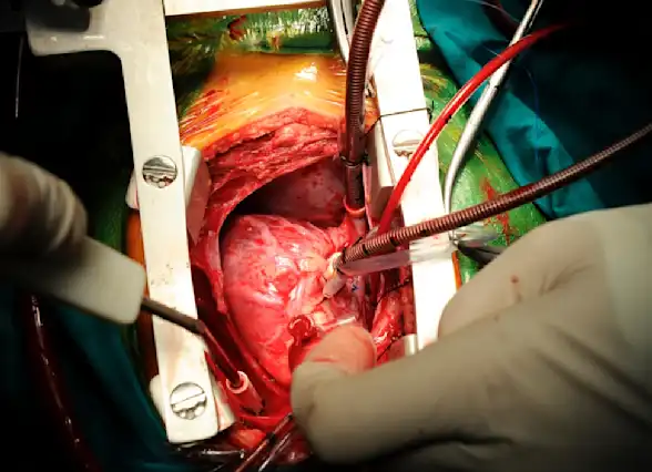 CABG Deifnition