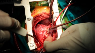 Coronary Artery Bypass Graft (CABG) Surgery