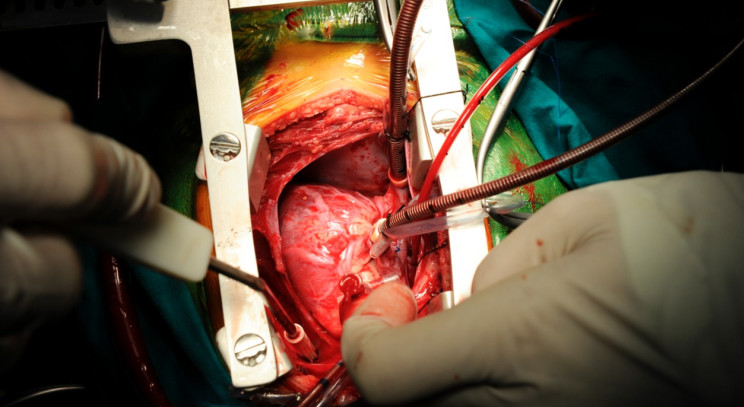 Cirugía de bypass aortocoronario (CABG)