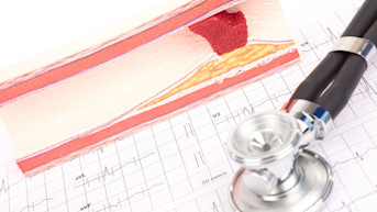 Indicaciones del bypass aortocoronario (CABG)