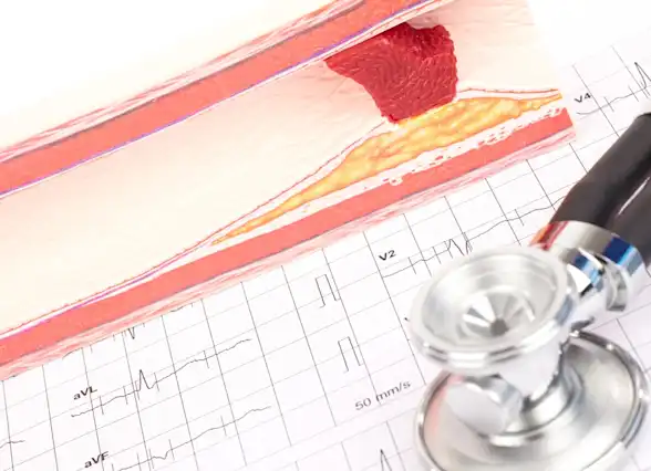 Indications for CABG