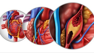 Definición de injerto de derivación aortocoronaria (CABG)