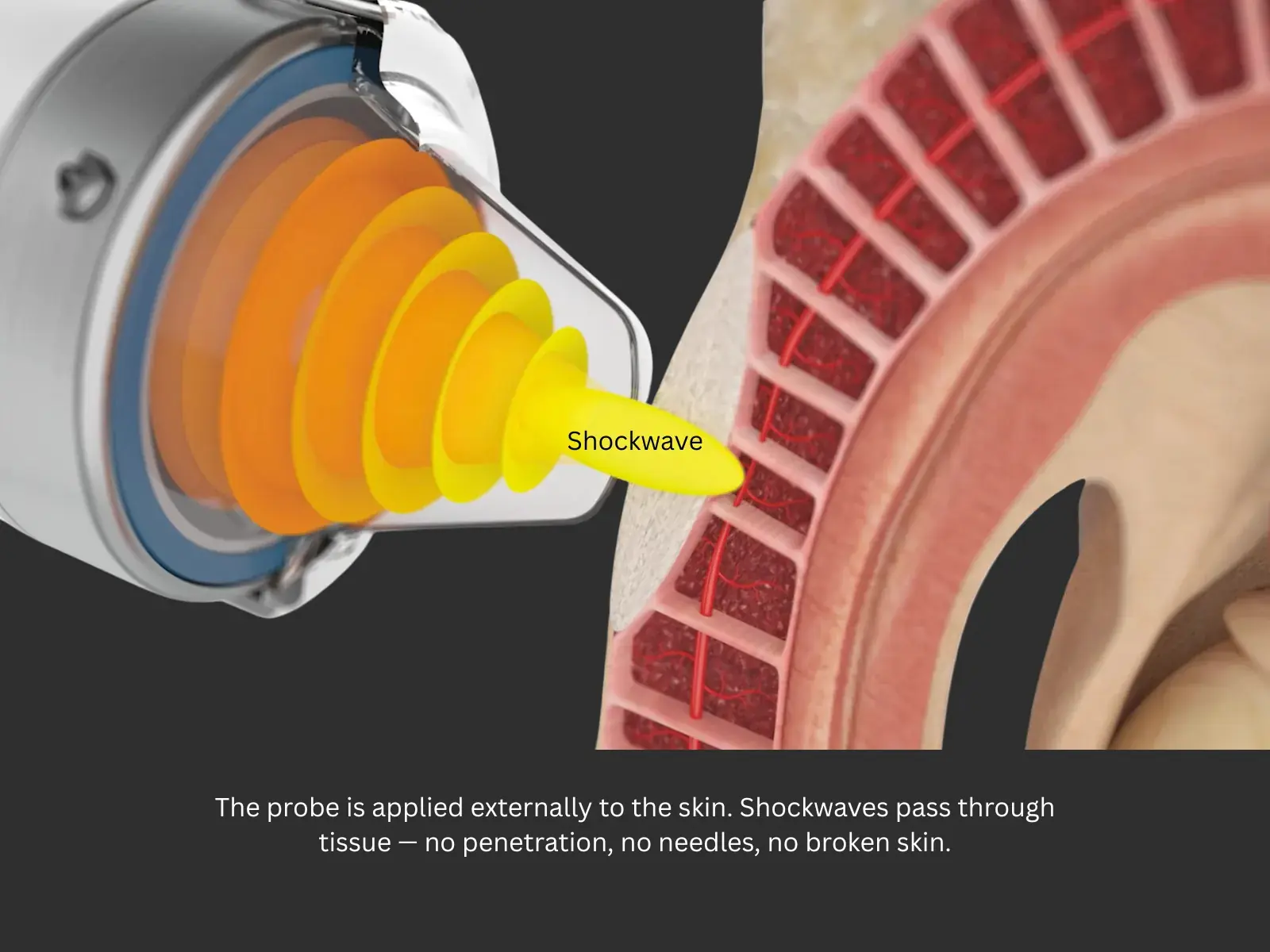 The probe is applied externally to the skin. Shockwaves pass through tissue — no penetration, no needles, no broken skin.
