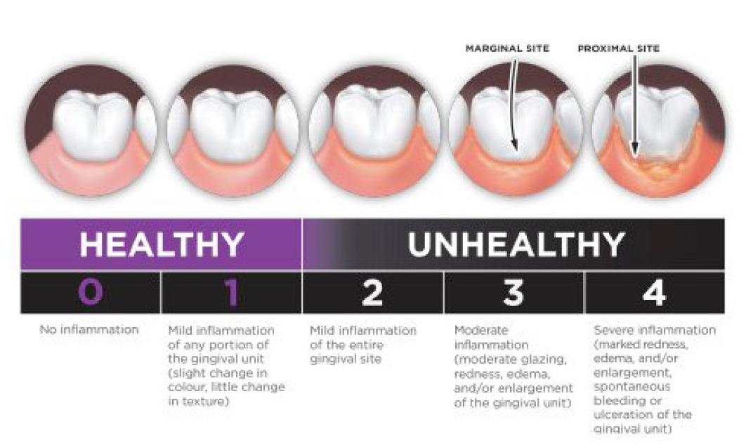 Modified gingival index-1