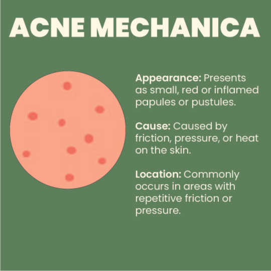 Acne Mechanica