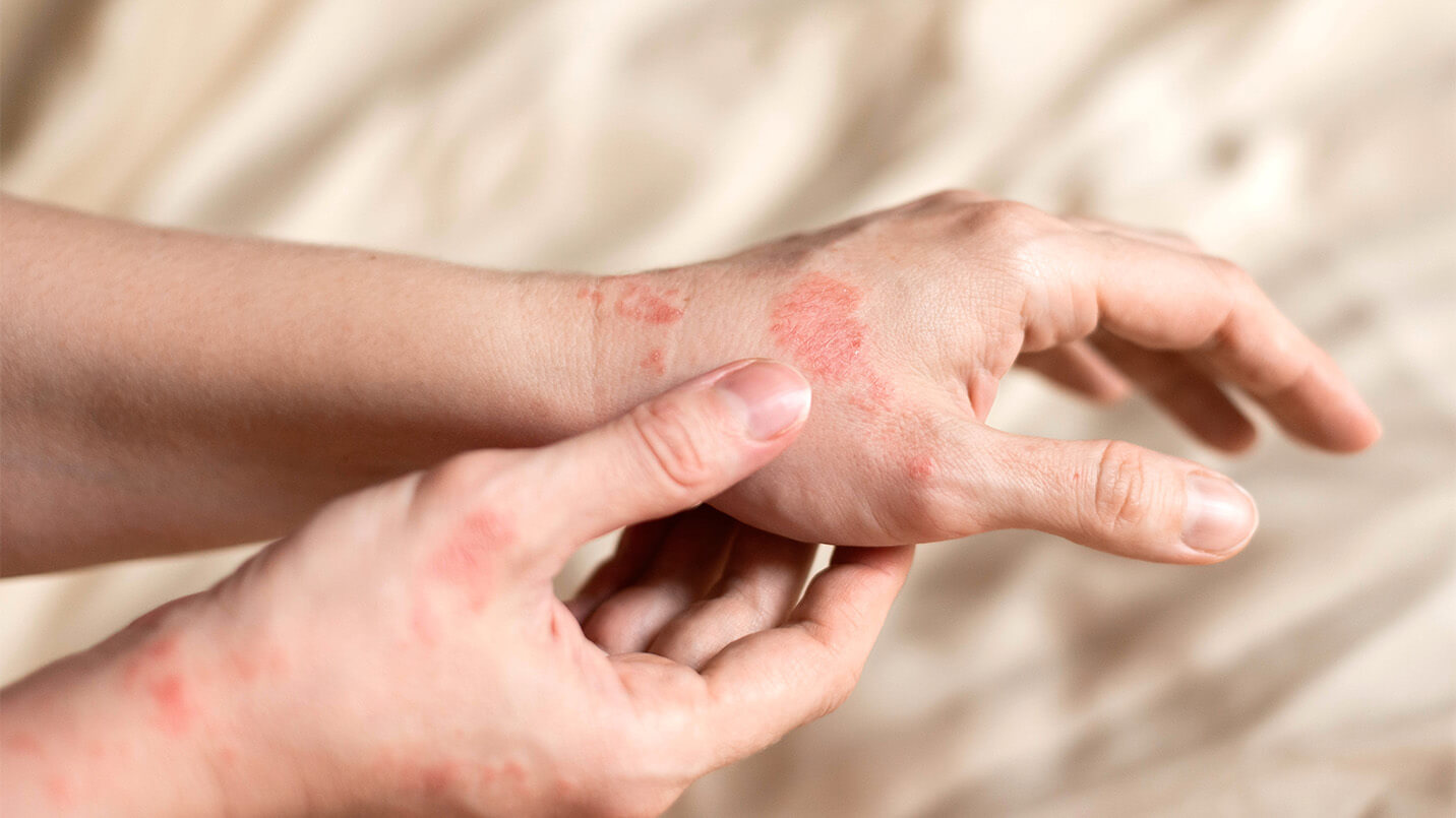 image of male hand with red, irritated eczema rash (dermatitis) 