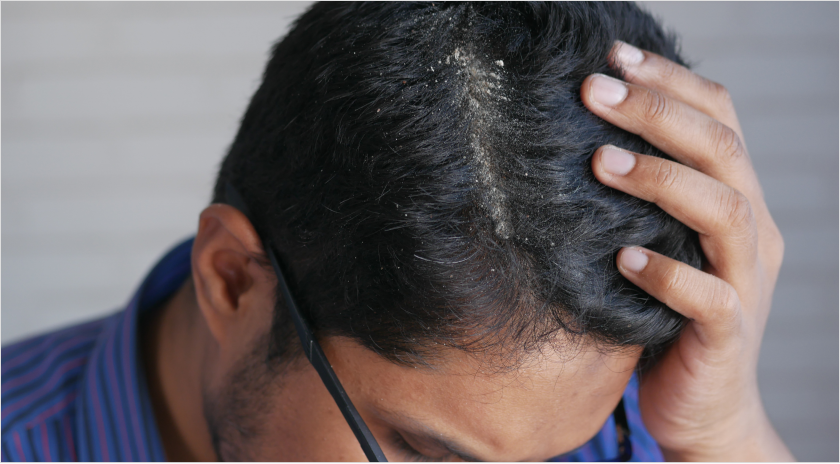 Closeup of a man's scalp that shows some white particles in his hair.