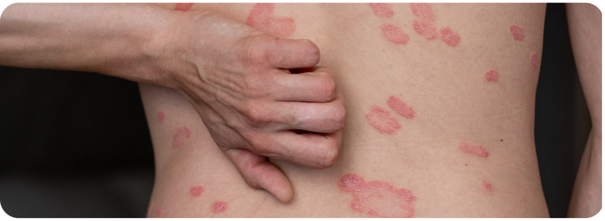 Urticaria causas