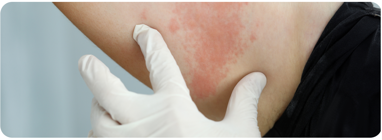 como-previnir-urticaria