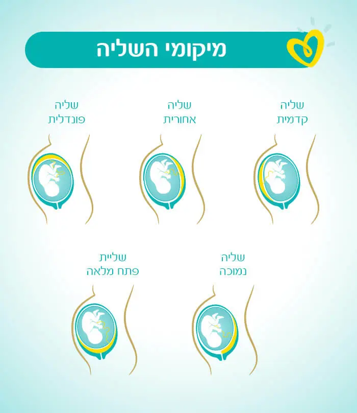 סוגי שליה-Article Content Image- infographic סוגי שליה