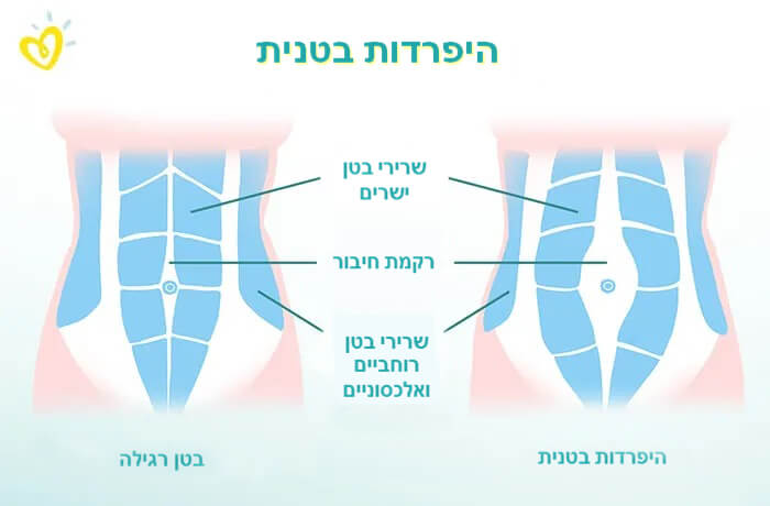 היפרדות בטנית-Article Content Image היפרדות בטנית