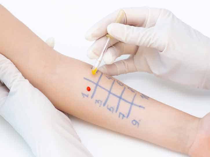 Allergy skin testing