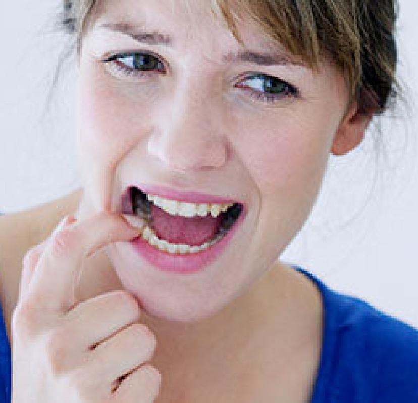 Gum Irritation and Sensitive Teeth from Whitestrips Crest CA