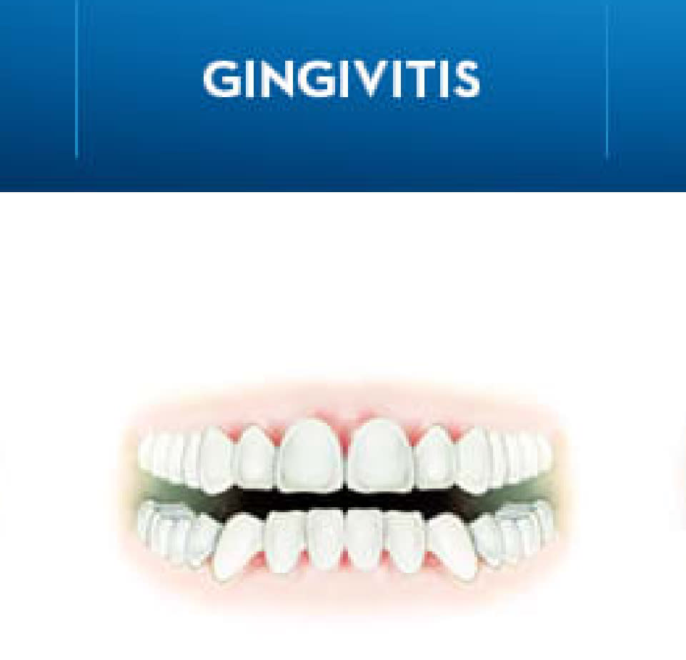 What is Gingivitis Symptoms, Causes, and Treatments Crest CA