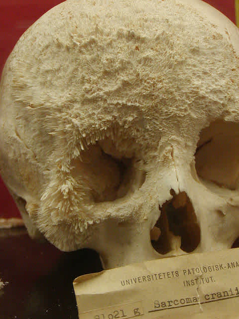 Sarcoma Cancer patient skull bones