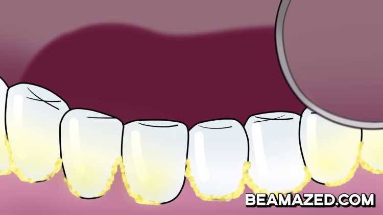  Teeth plaque oral dental hygiene yellowing teeth