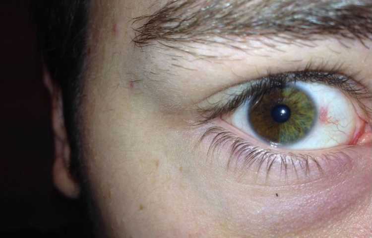 sectoral heterochromia Multicoloured Eyes split down middle