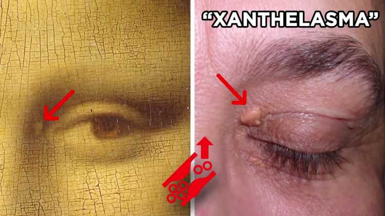 Mona Lisa Secrets You Aren't Aware Of high cholesterol xanthelasma under eye
