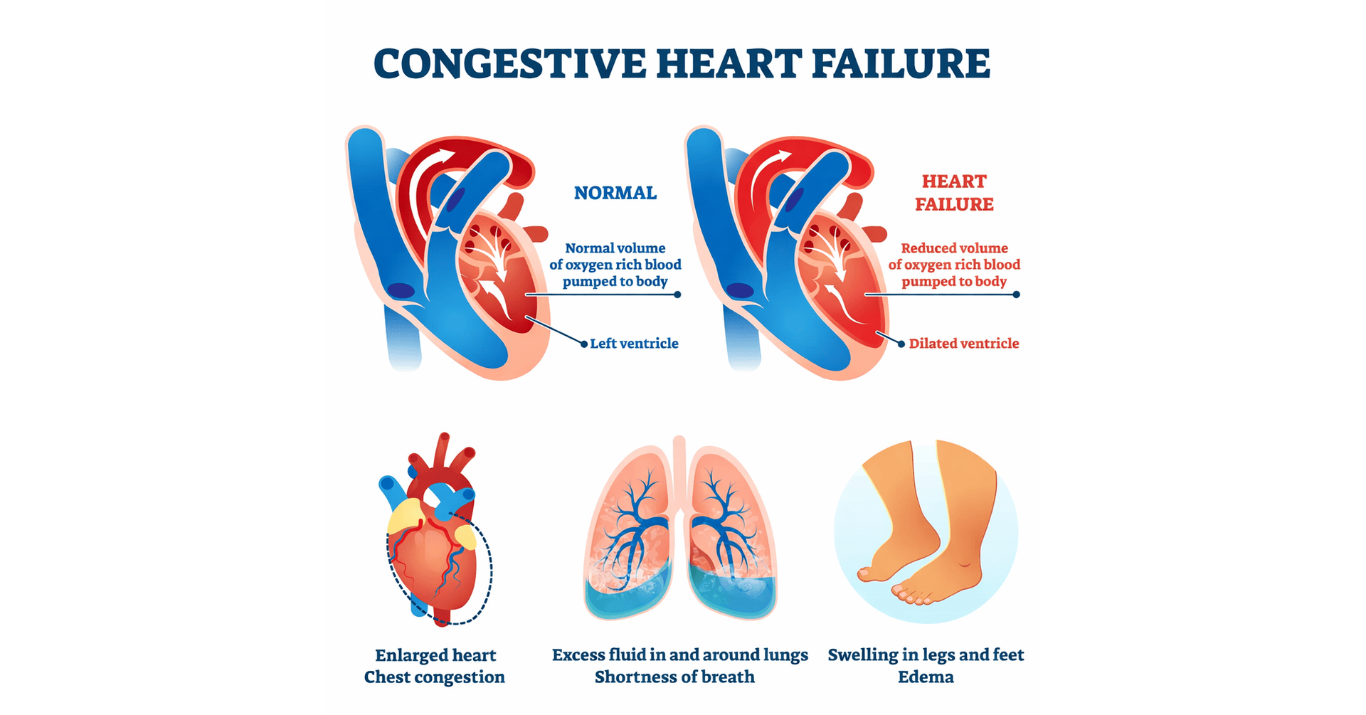 Infographic comparing normal heart vs congestive heart failure showing reduced blood flow, enlarged heart, fluid in and around lungs, and leg swelling (edema)
