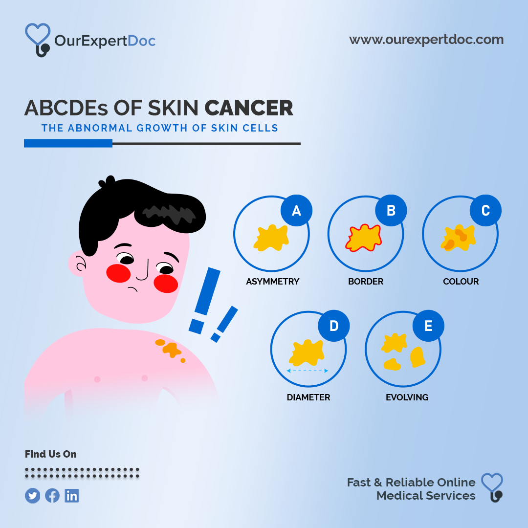 Infographic showing the ABCDE's of Skin Cancer