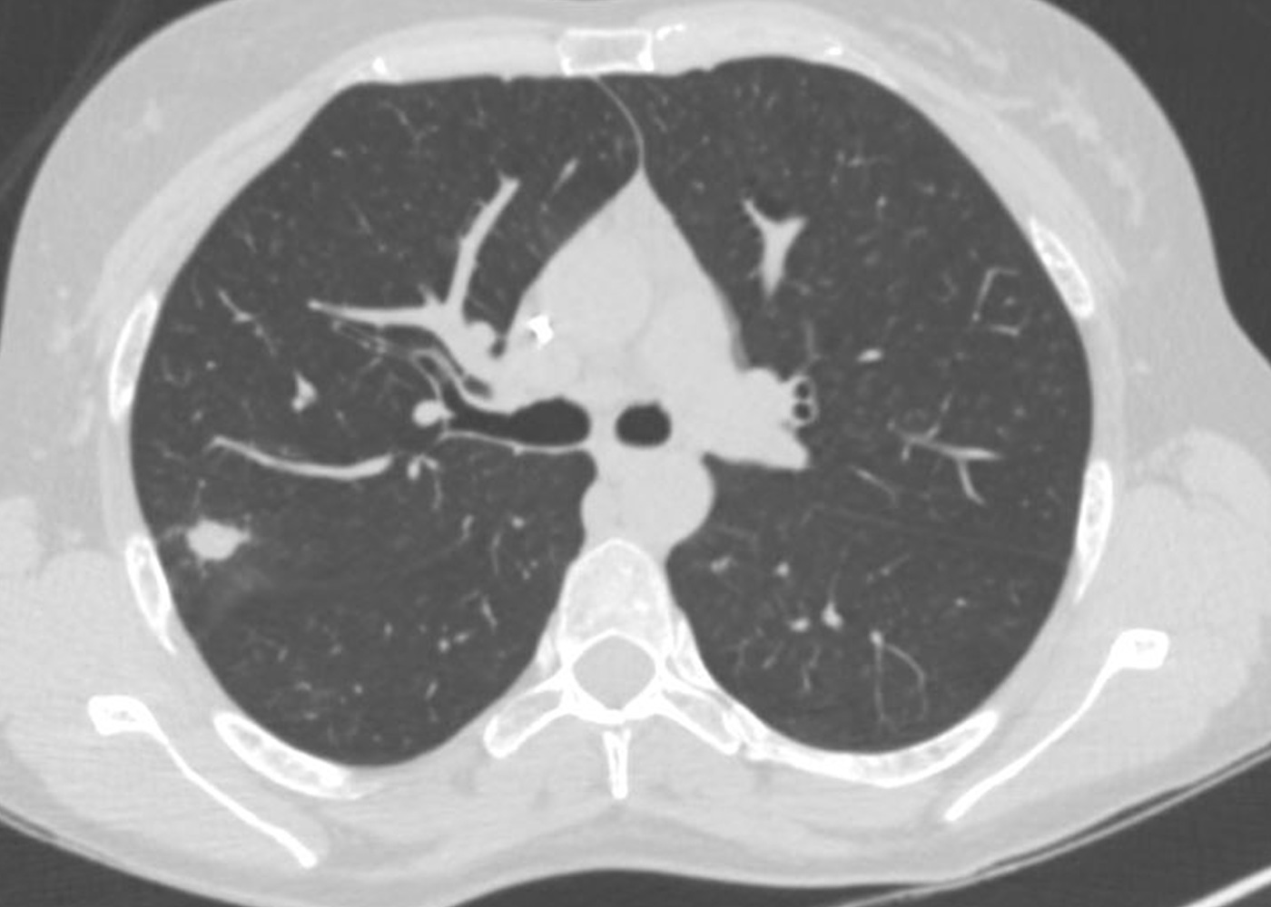 Fig 1. CT image of right upper lobe
lung nodule