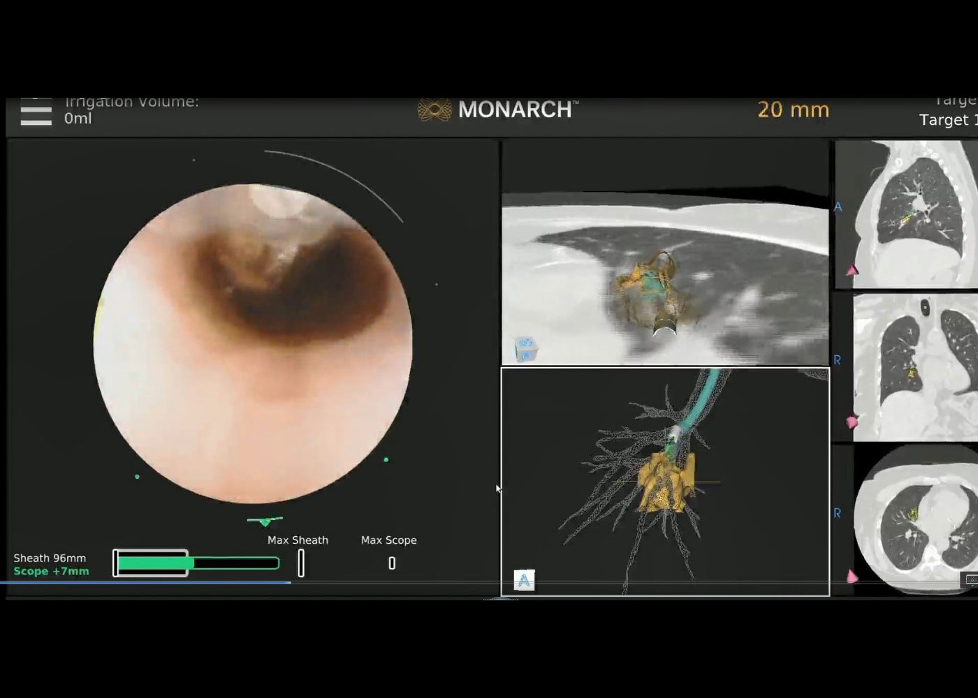 Fig 4. MONARCH® navigation screen showing deployment of biopsy tools