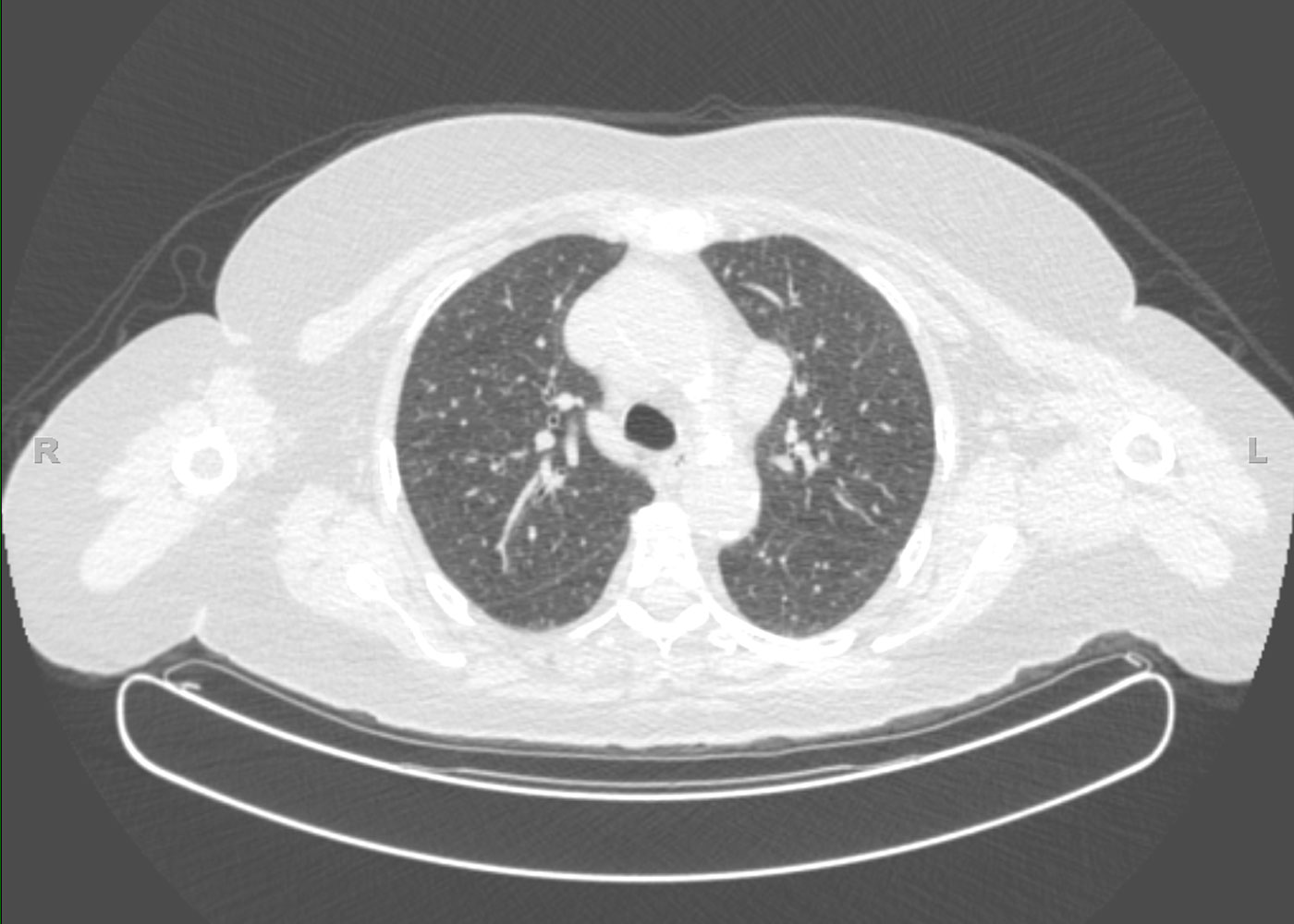 Fig 2. Endobronchial image showing extrinsic compression