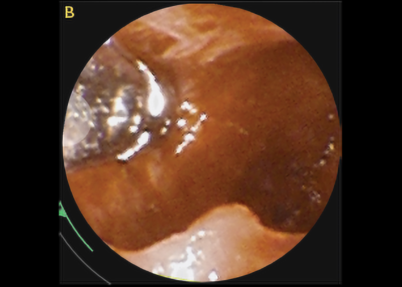 Fig 3. Direct bronchoscopic image of the forceps within the cavitary left upper lobe nodule