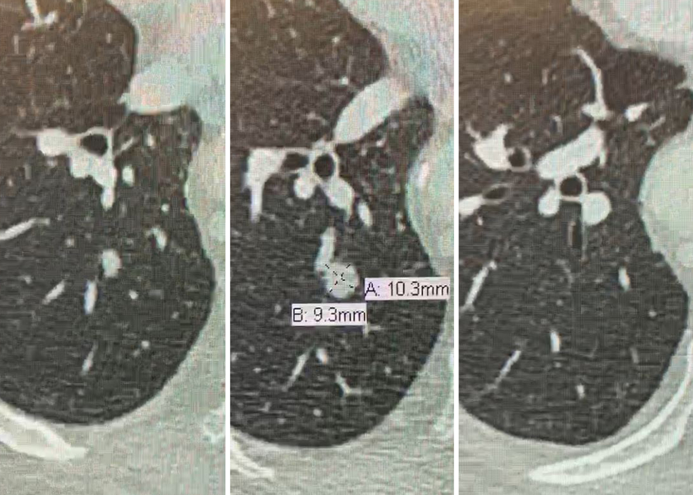 Fig 2.CT images showing lung nodule
and nearby bronchi