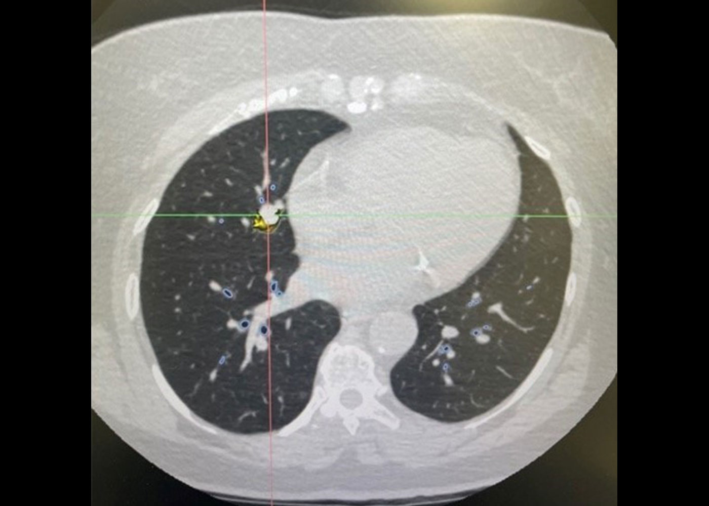 Fig 1. MONARCH® planning software interface showing small lung nodule
