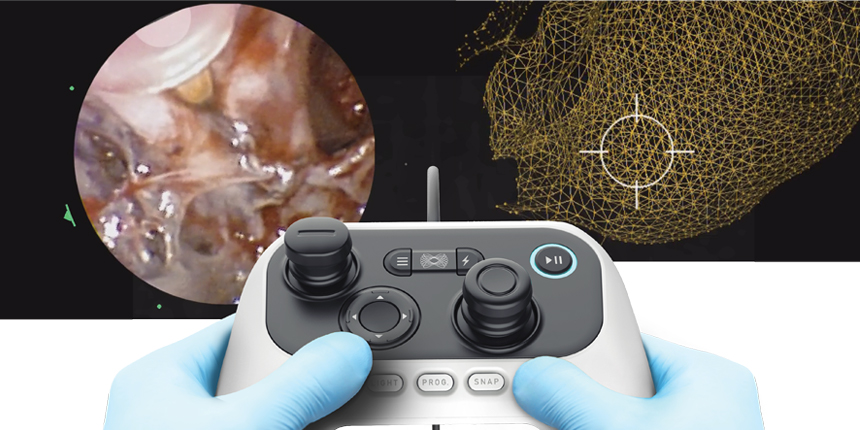 Bronchoscopy aided by Monarch robotic technology