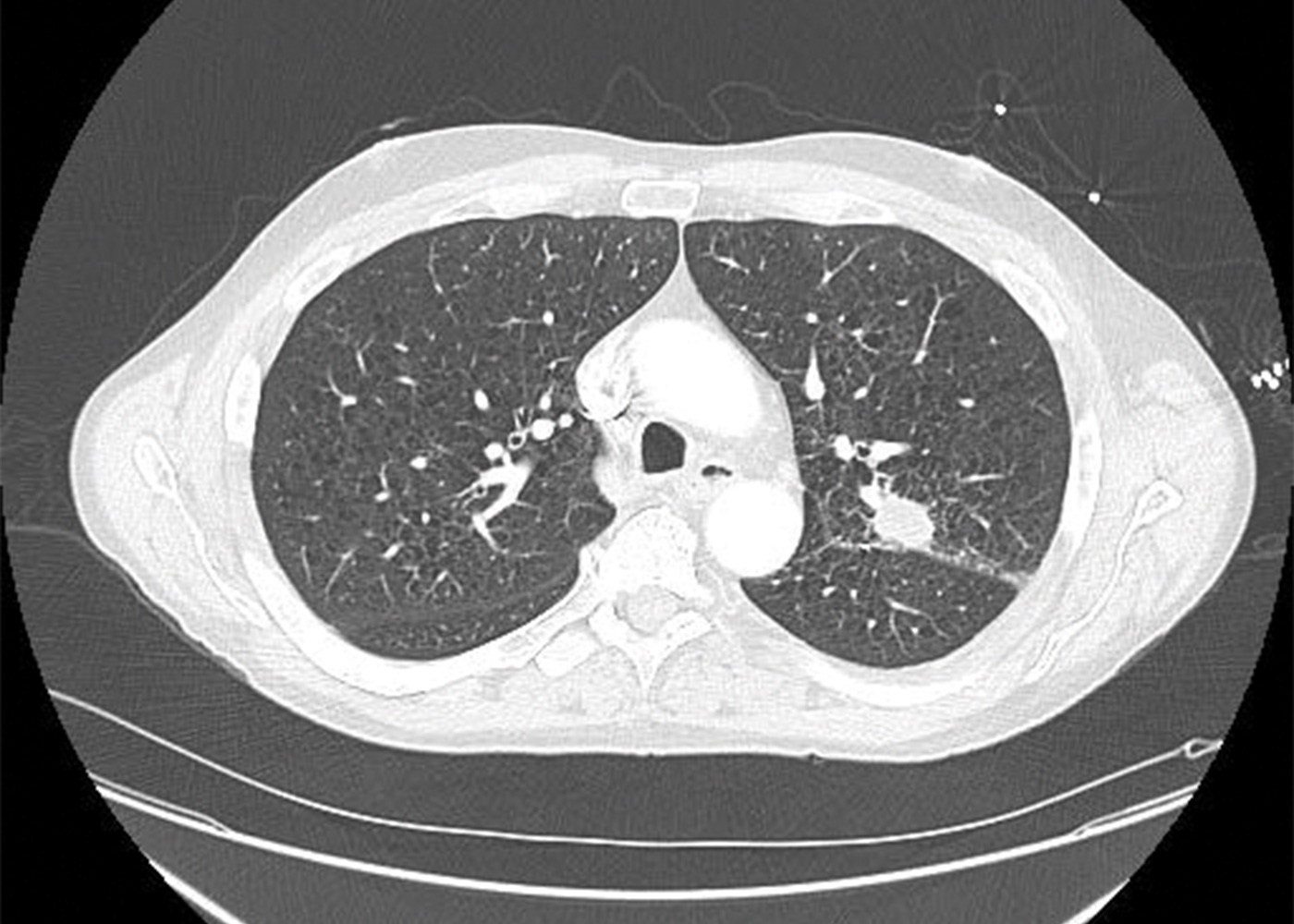 Fig 2. CT Scan